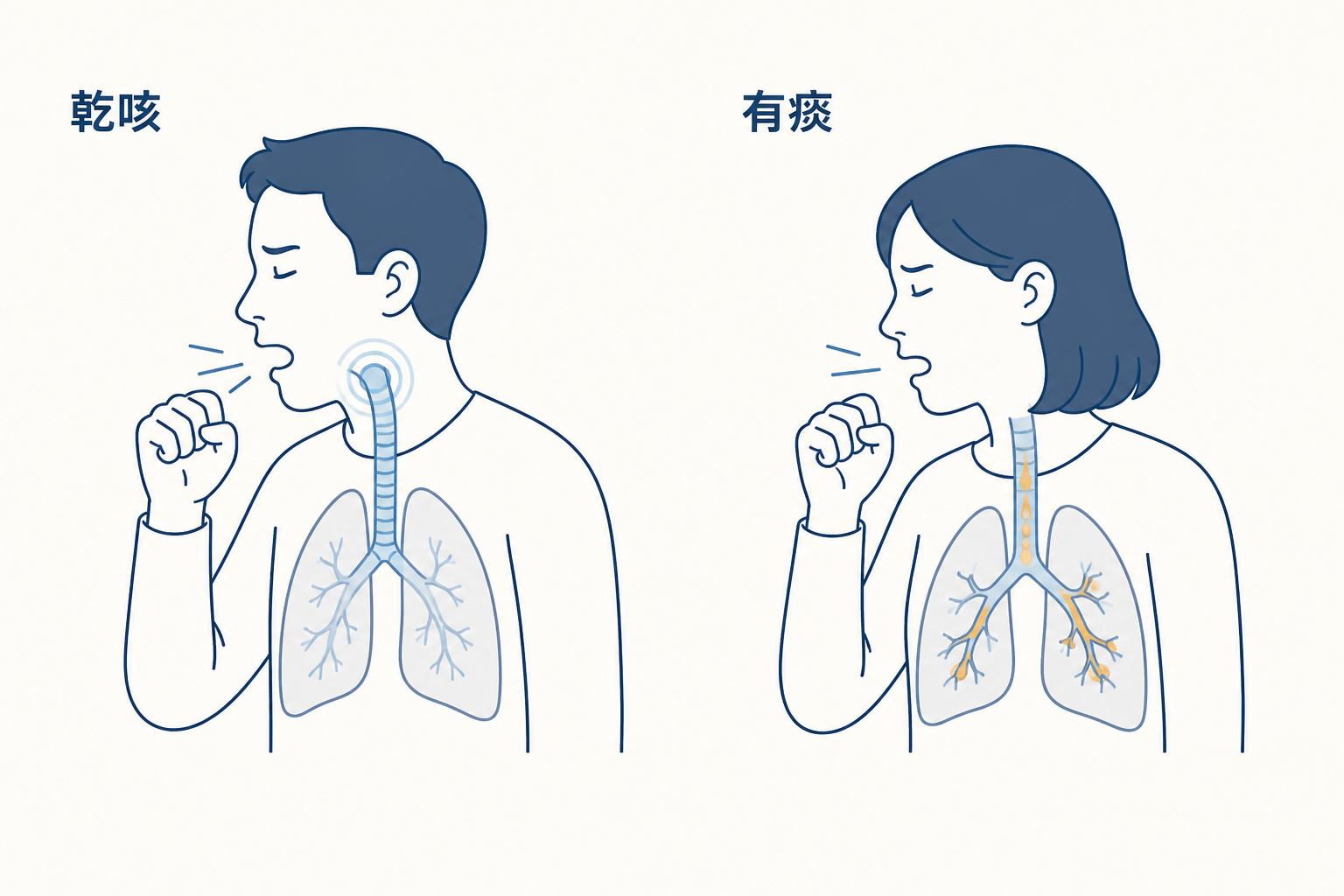 乾咳與有痰咳嗽的分辨示意圖：左為乾咳（喉嚨乾燥刺激），右為有痰的咳嗽（氣管分泌物），兩者的用藥方向不同