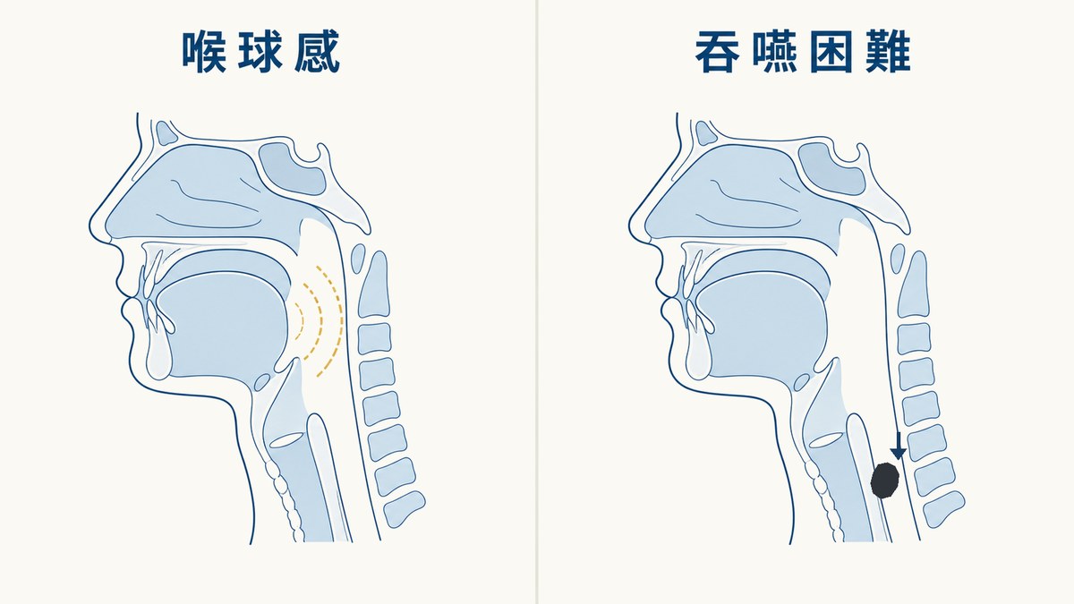 左右對照示意圖：左為喉球感，咽喉沒有實體異物僅以虛線波紋表示感覺；右為吞嚥困難，食道入口有實心食物團塊阻擋