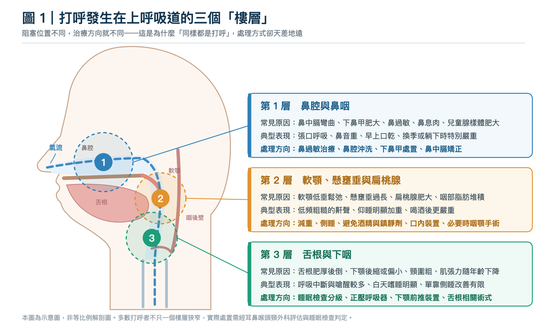 上呼吸道矢狀面示意圖，標示打呼常見的三個阻塞層級：第一層鼻腔與鼻咽、第二層軟顎懸壅垂與扁桃腺、第三層舌根與下咽，以及各層的常見原因與處理方向