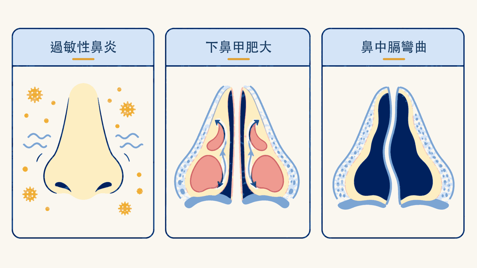長期鼻塞三大常見原因示意圖：過敏性鼻炎的黏膜發炎與過敏原刺激、下鼻甲肥大使鼻腔通道變窄、鼻中膈彎曲造成長期單側鼻塞